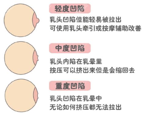 乳頭長毛|乳頭內凹、長毛正常嗎？ 8類「乳頭形狀」你的是哪種 